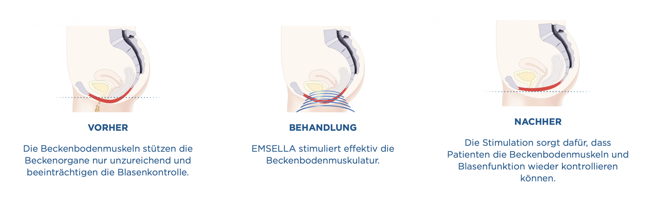 EMSELLA®-Therapie